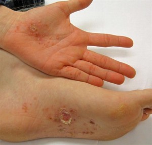 Relief Psoriasis and Eczema Treatment